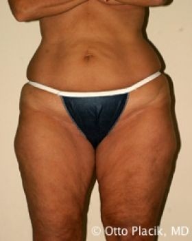 Thigh Lift - Before & After - Dr. Placik