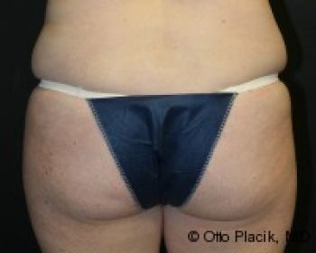 Thigh Lift - Before & After - Dr. Placik