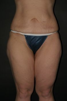 Thigh Lift - Before & After - Dr. Placik