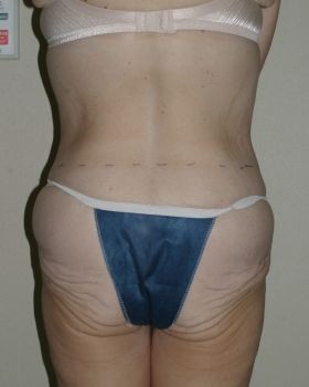 Thigh Lift Chicago