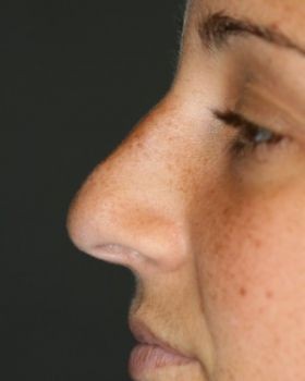 Rhinoplasty - Before & After - Dr. Placik