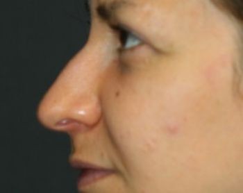 Rhinoplasty - Before & After - Dr. Placik