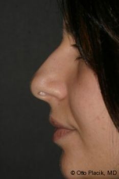 Rhinoplasty - Before & After - Dr. Placik