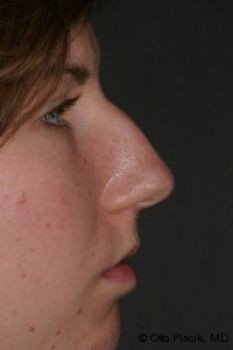 Rhinoplasty - Before & After - Dr. Placik