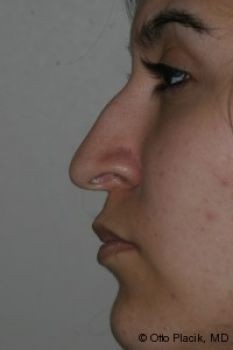 Rhinoplasty - Before & After - Dr. Placik