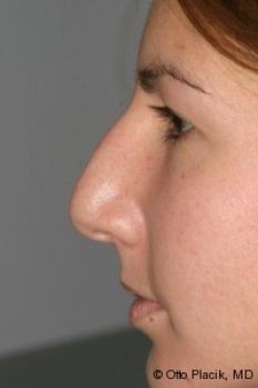 Rhinoplasty - Before & After - Dr. Placik