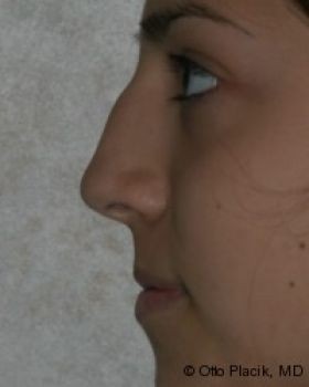 Rhinoplasty - Before & After - Dr. Placik