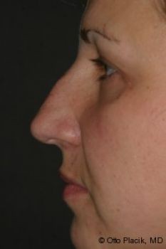 Rhinoplasty - Before & After - Dr. Placik