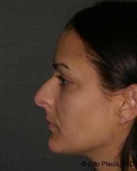 Rhinoplasty - Before & After - Dr. Placik