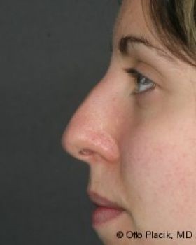 Rhinoplasty - Before & After - Dr. Placik