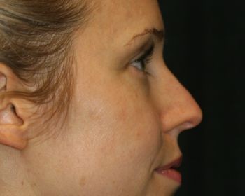 Rhinoplasty - Before & After - Dr. Placik