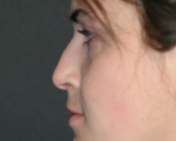 Rhinoplasty - Before & After - Dr. Placik