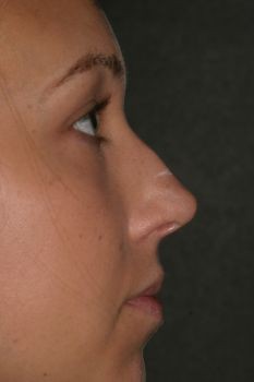 Non-Surgical Rhinoplasty - Before & After - Dr. Placik