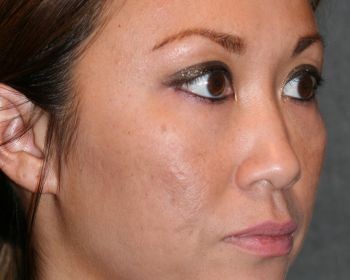 Non-Surgical Rhinoplasty - Before & After - Dr. Placik