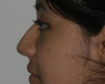 Non-Surgical Rhinoplasty - Before & After - Dr. Placik