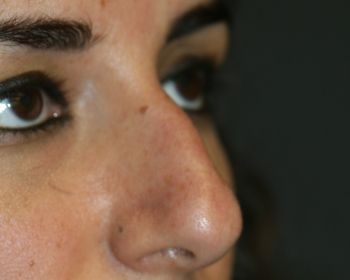 Non-Surgical Rhinoplasty - Before & After - Dr. Placik