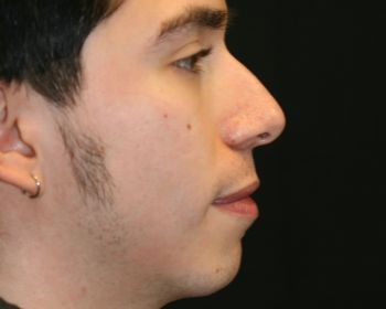 Non-Surgical Rhinoplasty - Before & After - Dr. Placik