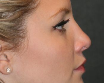 Non-Surgical Rhinoplasty - Before & After - Dr. Placik