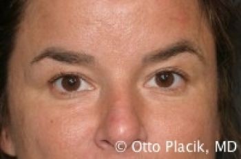 Eyelid Surgery - Before & After - Dr. Placik