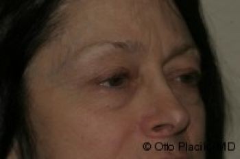 Eyelid Surgery - Before & After - Dr. Placik