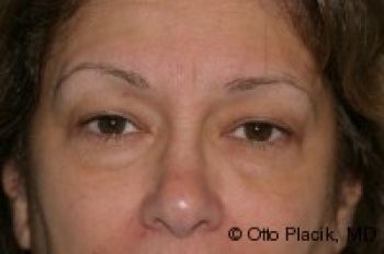 Eyelid Surgery - Before & After - Dr. Placik