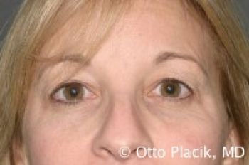 Eyelid Surgery - Before & After - Dr. Placik