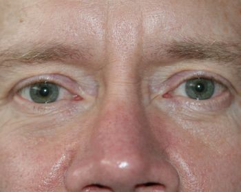 Eyelid Surgery - Before & After - Dr. Placik