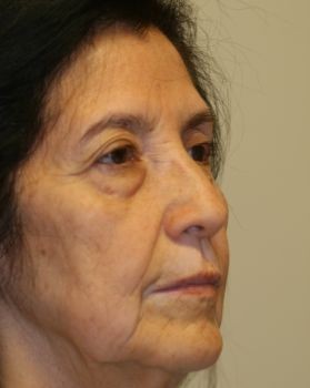 Face Lift - Before & After - Dr. Placik