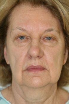 Face Lift - Before & After - Dr. Placik