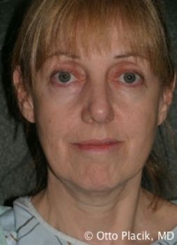 Face Lift - Before & After - Dr. Placik