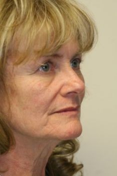 Face Lift - Before & After - Dr. Placik