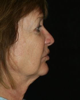 Face Lift - Before & After - Dr. Placik