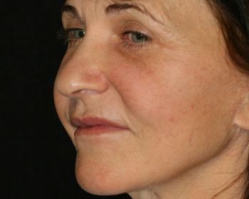 Face Lift - Before & After - Dr. Placik