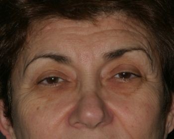 Brow Lift - Before & After - Dr. Placik