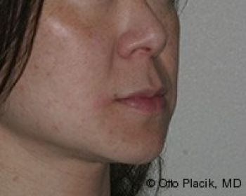 Buccal Fat Extraction - Before & After - Dr. Placik