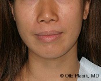 Buccal Fat Extraction - Before & After - Dr. Placik