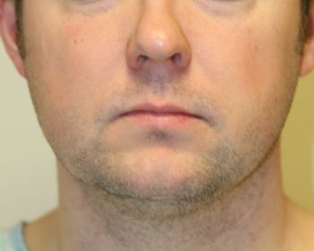 Buccal Fat Extraction - Before & After - Dr. Placik