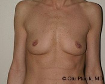 Before & After Breast Augmentation Gallery - Before & After - Dr. Placik