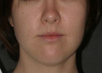 Buccal Fat Extraction - Before & After - Dr. Placik