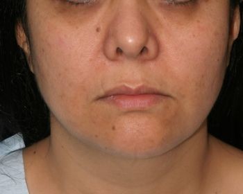 Buccal Fat Extraction - Before & After - Dr. Placik