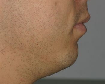 Buccal Fat Extraction - Before & After - Dr. Placik