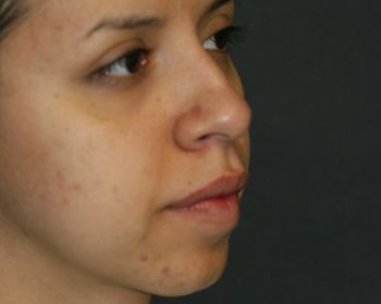 Buccal Fat Extraction - Before & After - Dr. Placik