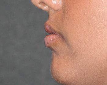 Lip Enhancement - Before & After - Dr. Placik