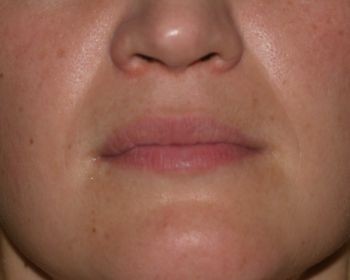 Lip Enhancement - Before & After - Dr. Placik