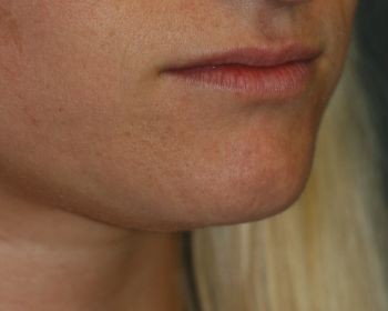 Lip Enhancement - Before & After - Dr. Placik