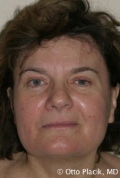 Multiple Facial Procedures - Before & After - Dr. Placik