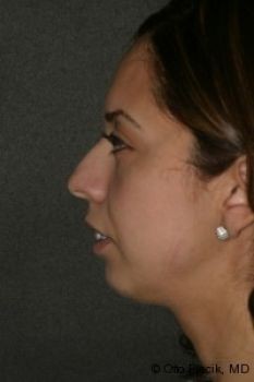 Chin Surgery - Before & After - Dr. Placik