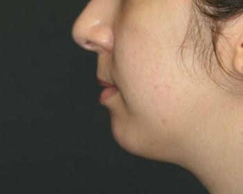 Chin Surgery - Before & After - Dr. Placik