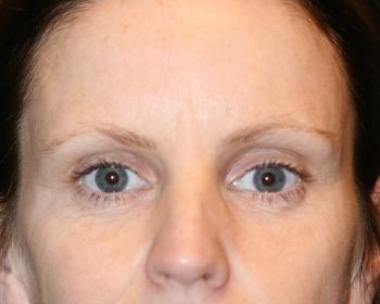 Injectable Filler - Before & After - Dr. Placik