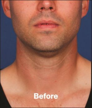 Kybella - Before & After - Dr. Placik